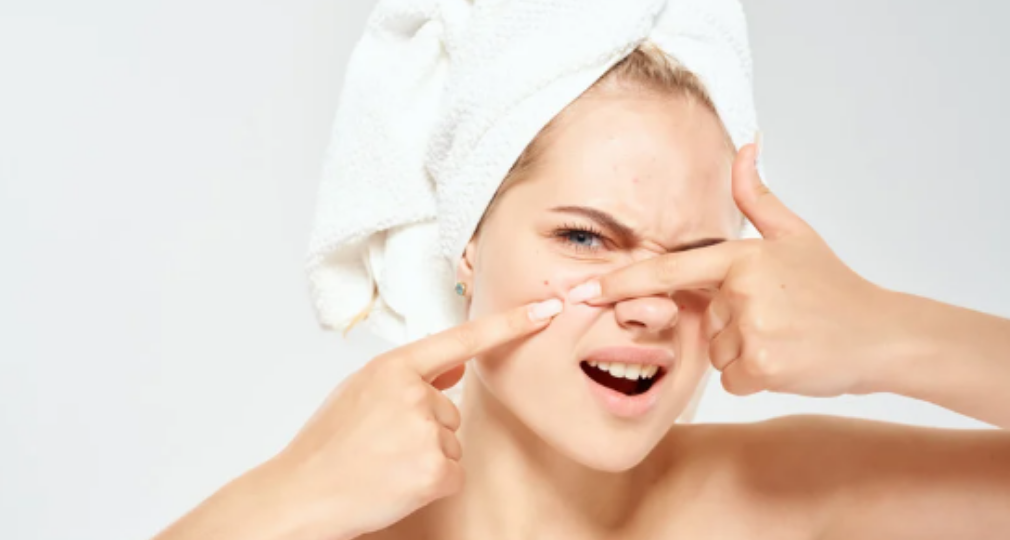 Boutons à 30 ans : pourquoi votre peau fait sa crise d’ado