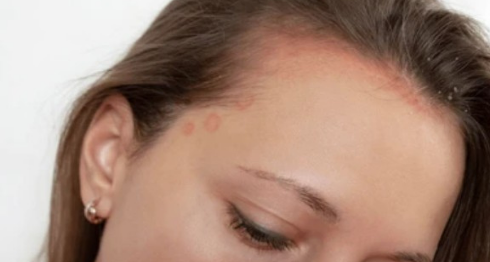 Psoriasis : et si vous appreniez enfin à aimer votre peau ?